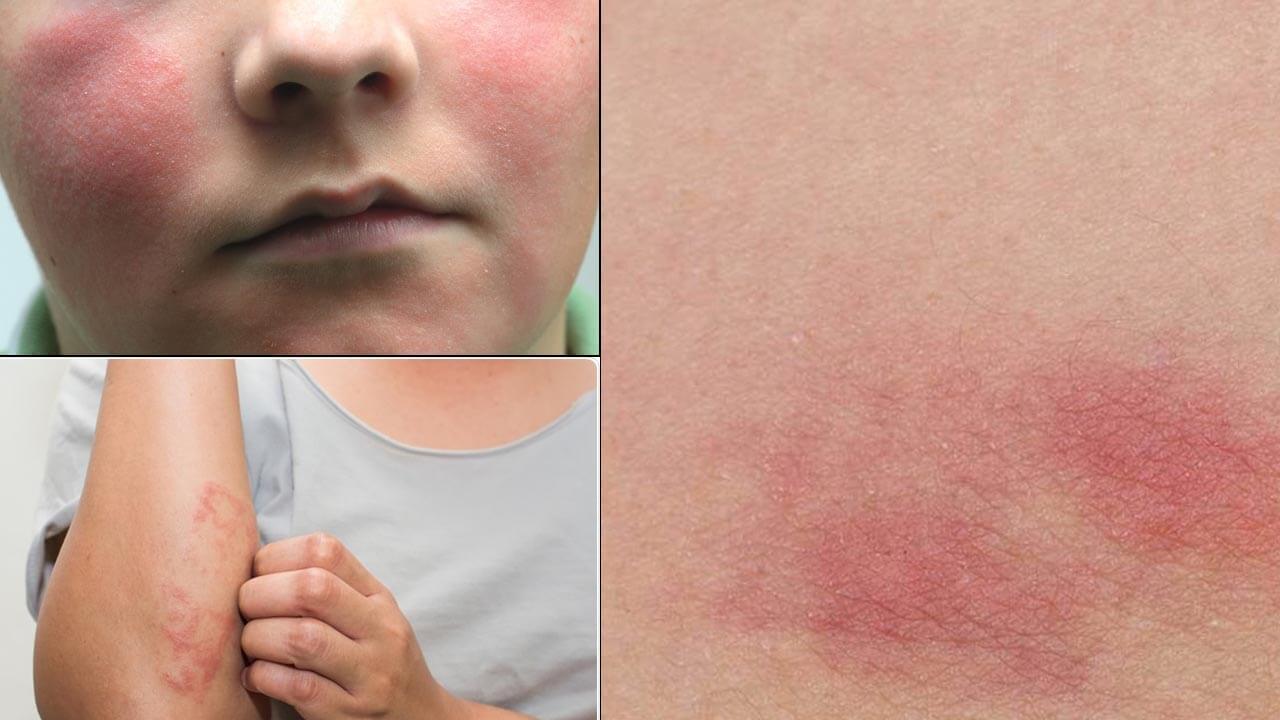 What are Rashes and How to Get Rid of Rashes - Treatments ...