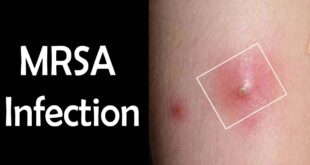 MRSA Infection