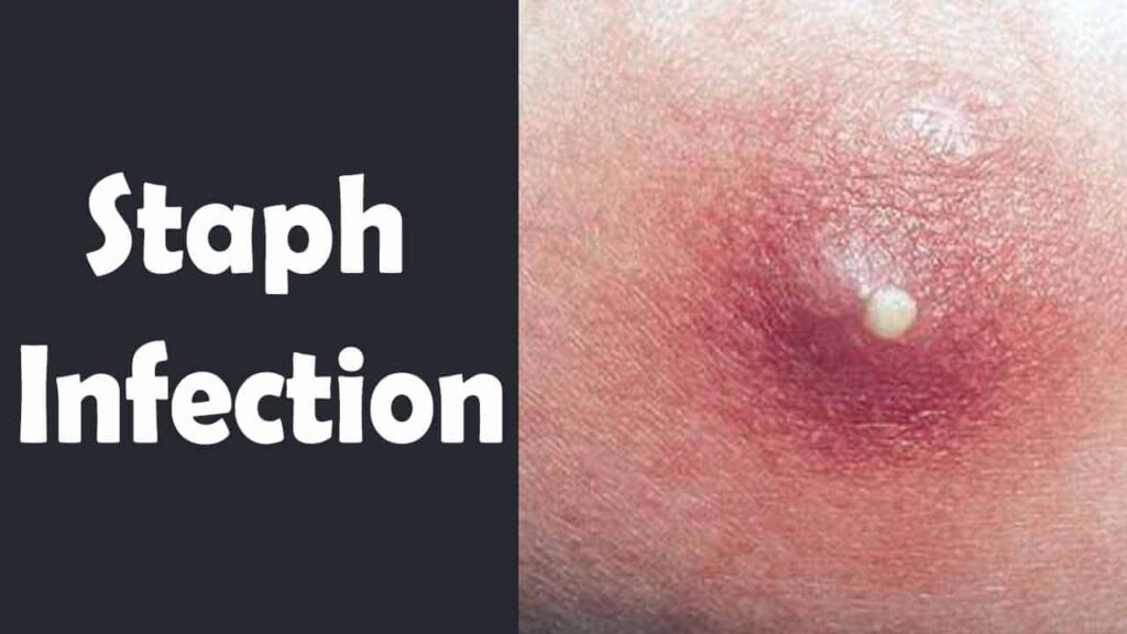 3 Ways To Treat A Staph Infection Using Natural Remedies 8960