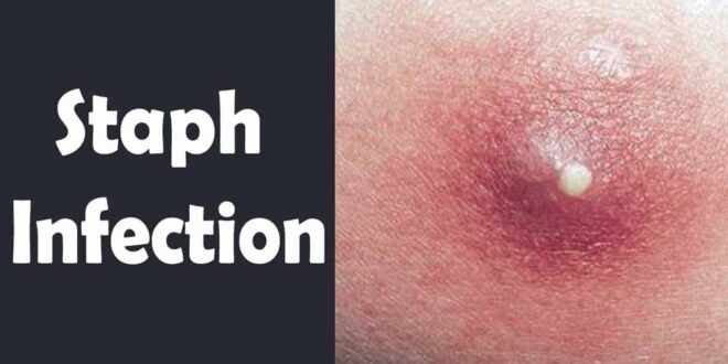 3-ways-to-treat-a-staph-infection-using-natural-remedies