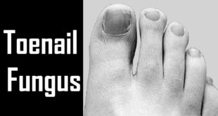 Toenail Fungus