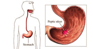 Common Causes that Lead to Peptic Ulcers