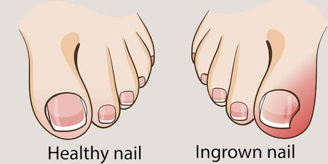 Cause and Painless Home Remedies for Ingrown Toenails