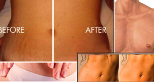 How to Get Rid of Stretch Marks